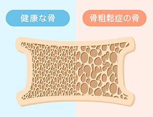 希少な骨粗鬆症外来
